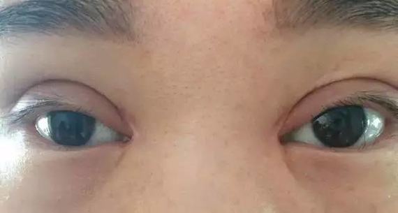 是没有削薄切除多余的眼轮匝肌,使上眼睑的眼轮匝肌肥厚堆积造成的