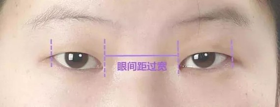 正常眼距是一个眼睛的距离,如果眼间距>眼裂长,就是眼间距过宽,如下图