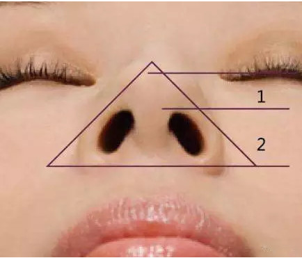 鼻孔形状不佳怎么矫正?