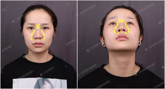 矮!的鼻子看着就土不仅看着土味十足_圈子-新氧美容整形