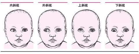 斜颈大小脸大小眼图片图片