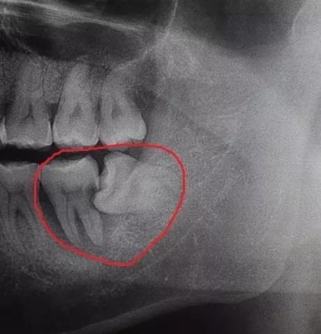 上第三磨牙图片