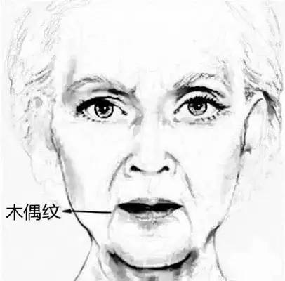 法令纹非常显老 即使笑得再如沐春风 也难掩老态 木偶纹 03 嘴角
