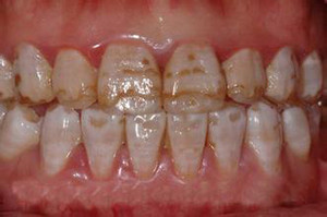 很多人因为牙齿黄而苦恼,那么是什么原