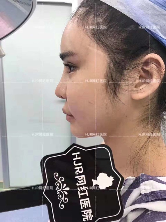 我们家紫萱小姐姐三个月肋骨隆鼻术后效果