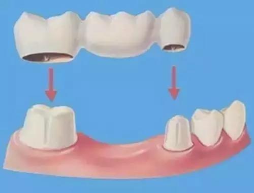固定式的修复,通过口腔粘膜与义齿基托形成的负压或剩余牙齿作为依托