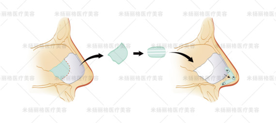 隆鼻,为什么首选鼻中隔