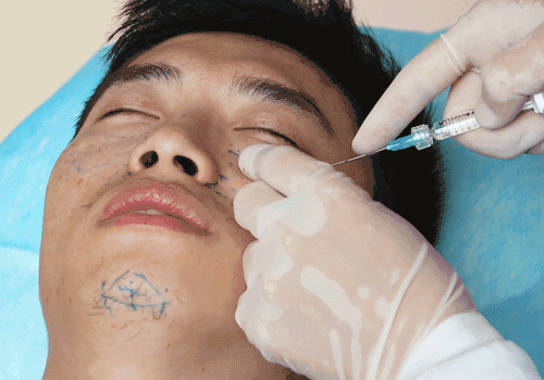 开始注射苹果肌,因为注射前已经敷过麻药了,所以注射过程中并