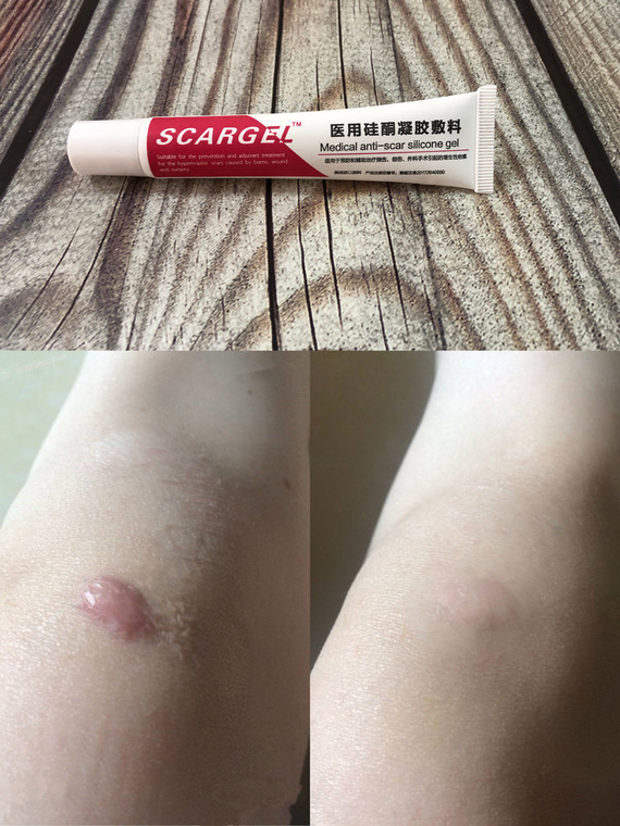 这个药膏对疤痕增生很有效,我用过康瑞保,疤克,美皮护,虽然对疤痕效果