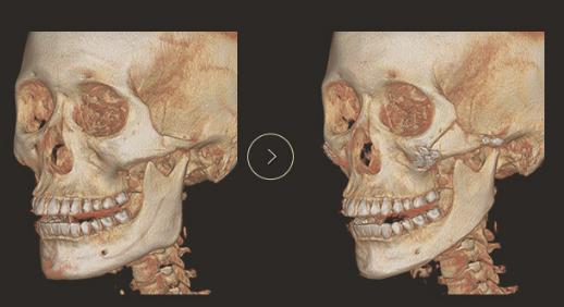 da整形医院【颧骨,下颌角缩小真实案例ct图】