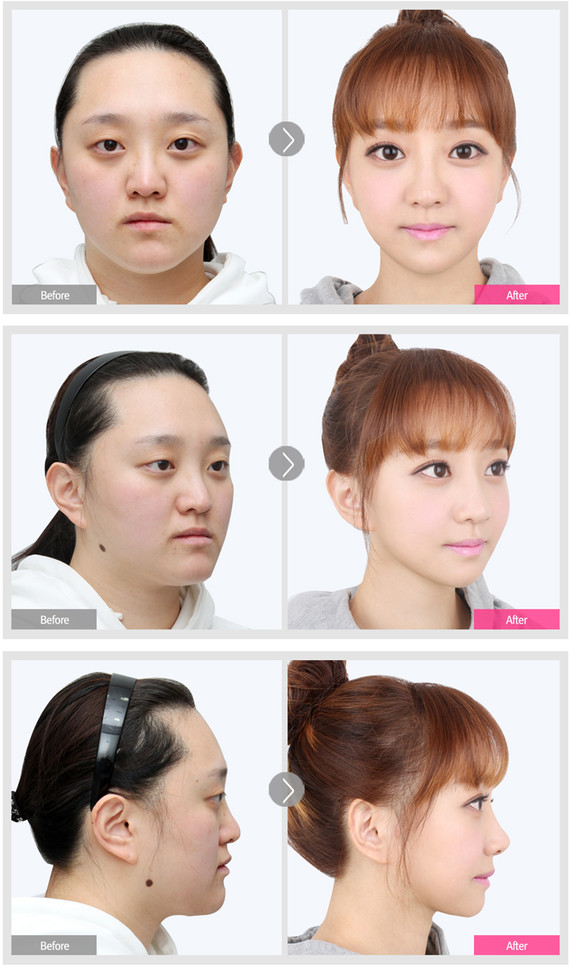 韩国整形真人秀,双鄂手术改变人生说的就是她!