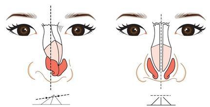 鼻骨矫正有什么危害吗 歪鼻矫正手术知识点大扫盲 新氧尺颜