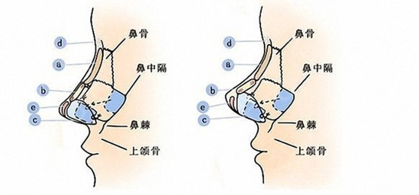 肋软骨隆鼻示意图图片