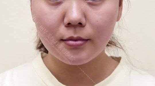 鼻翼基底凹陷用什么填充能改善?