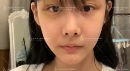 你好这是我鼻子的照片我想咨询一下手术 新氧美容整形