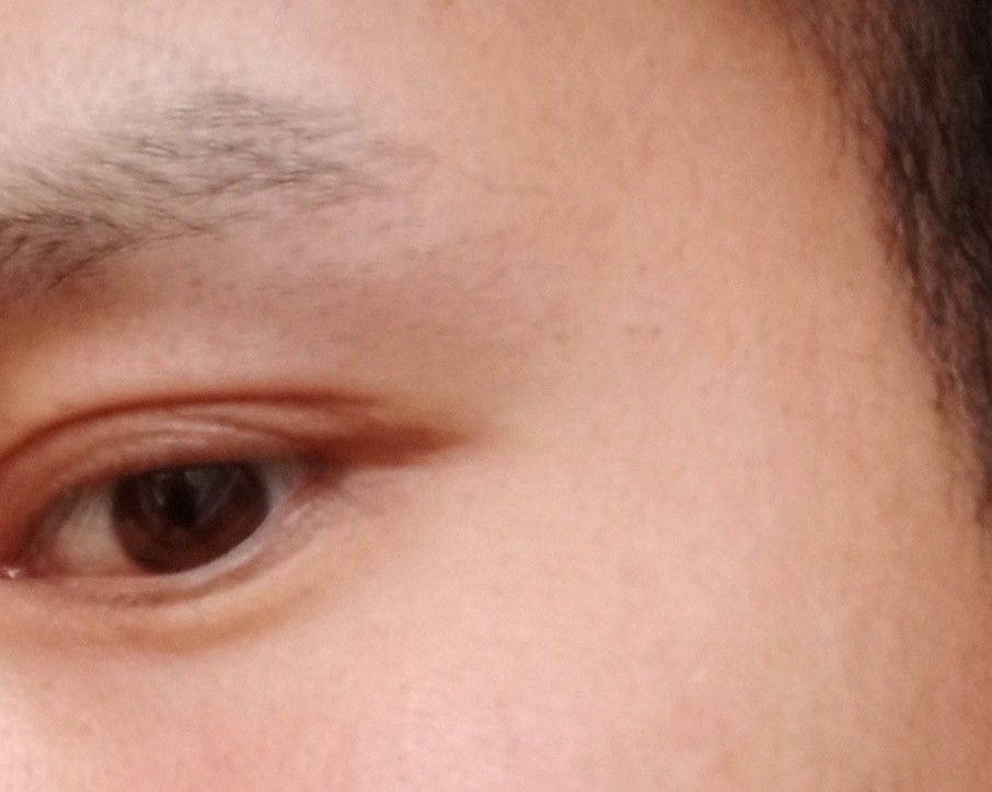 双眼皮修复后15天眼尾出现分叉多出一道褶子现在32天了未消除请问是