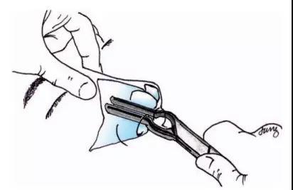 示使用鼻骨复位器将塌陷部位的鼻骨上抬至适当的位置,同时在外鼻