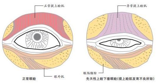 麻痺性上瞼下垂:動眼神經麻痺所致.