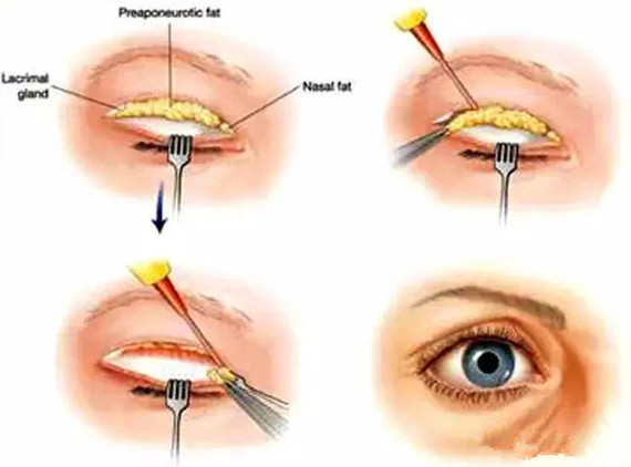 重睑手术对眼功能问题的几点考虑