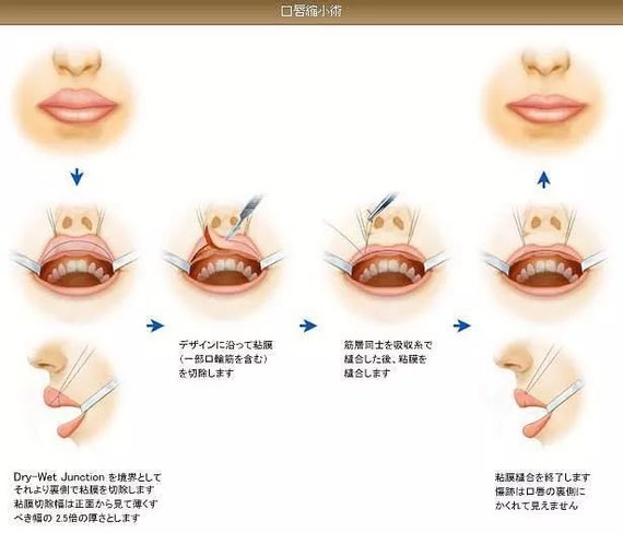 缩唇手术过程图片图片