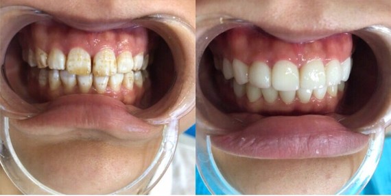 氟斑牙的问题困扰了我很长时间,经常有人问我吃了什么_圈子-新氧美容