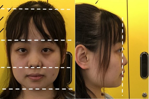 夏天三庭之中,上中庭稍长,比例上偏幼态;短圆脸型,五官也是多圆,钝