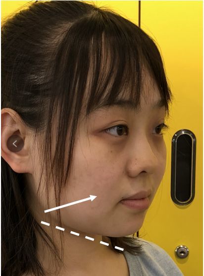 下半张脸软组织饱满,婴儿肥也带来奶气与弱攻击性;但有轻微下垂迹象