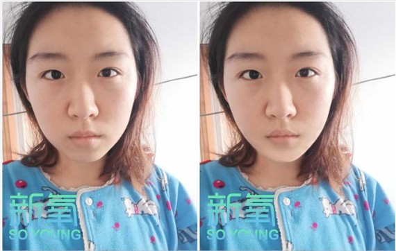 整容脸长的一样_整容脸长什么样_脸太长怎么整容