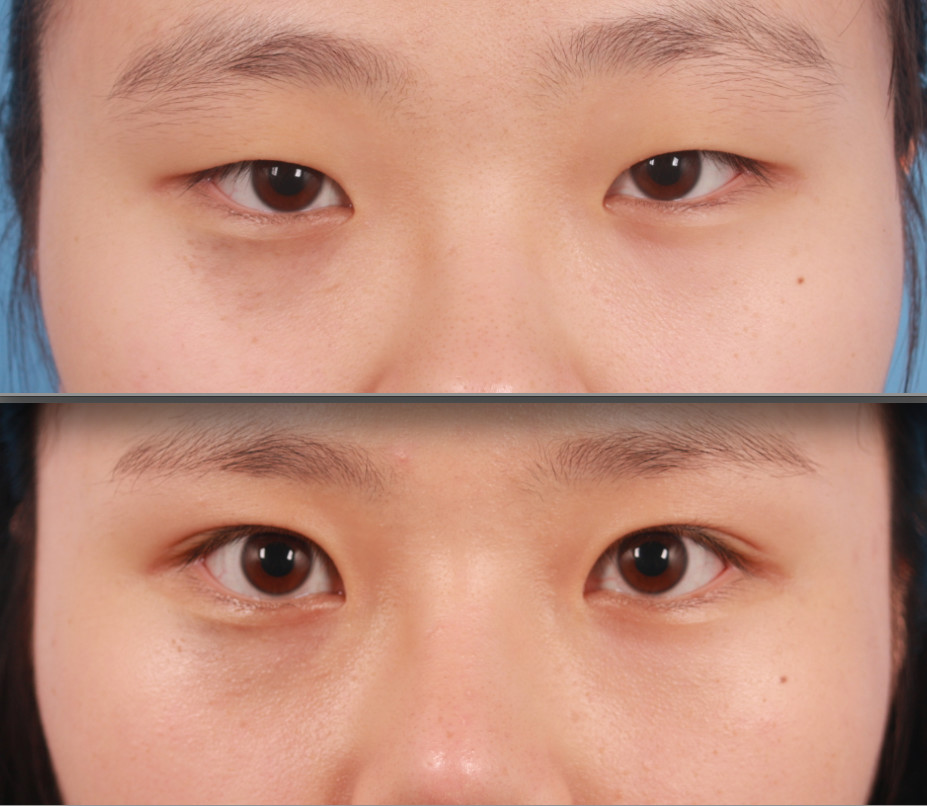 因为韩国也有不少单眼皮的人,还没成为眼整形医生之前,我也曾有过