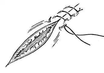 【缝合术干货】整形缝合术跟缝衣服一样?