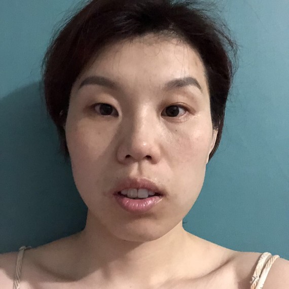 深受龅牙,上牙骨长且外凸,一笑露牙龈的影响,一笑就_圈子-新氧美容