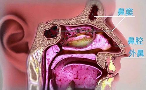 现在城市空气质量不好,有的人会有急性鼻炎,有的人则有慢性鼻炎,不