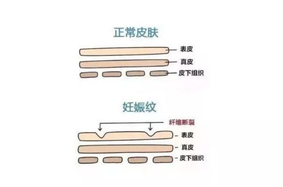 皮肤内弹性纤维断裂图图片