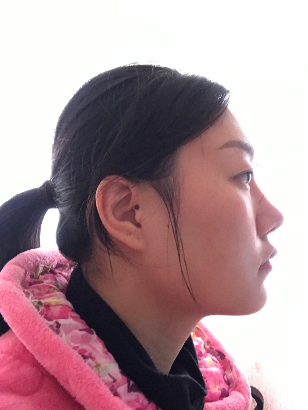 面部吸脂,人中延长!一直打算去日本换换头.