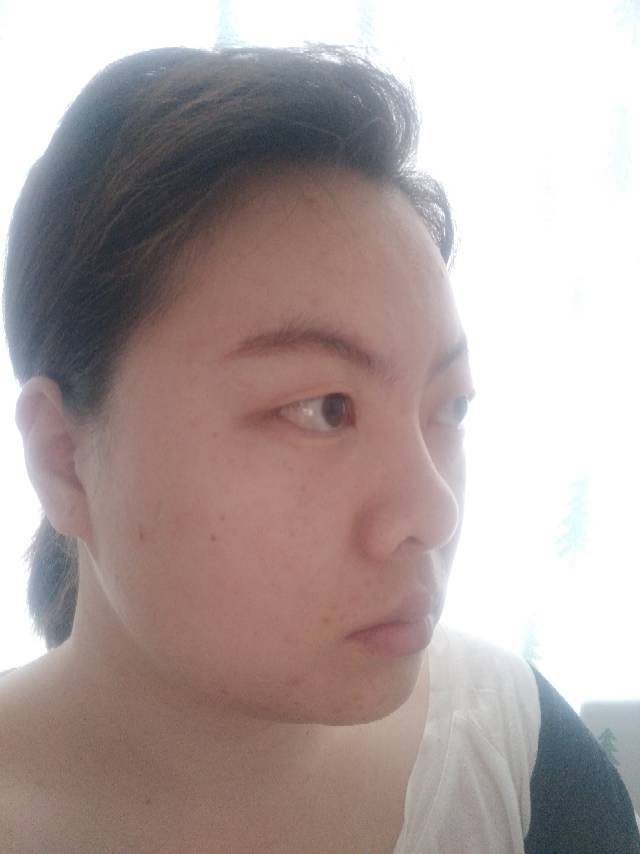 尤其是侧面,眼球突出,鼻子短鼻孔外露,下巴有点后缩_圈子-新氧美容