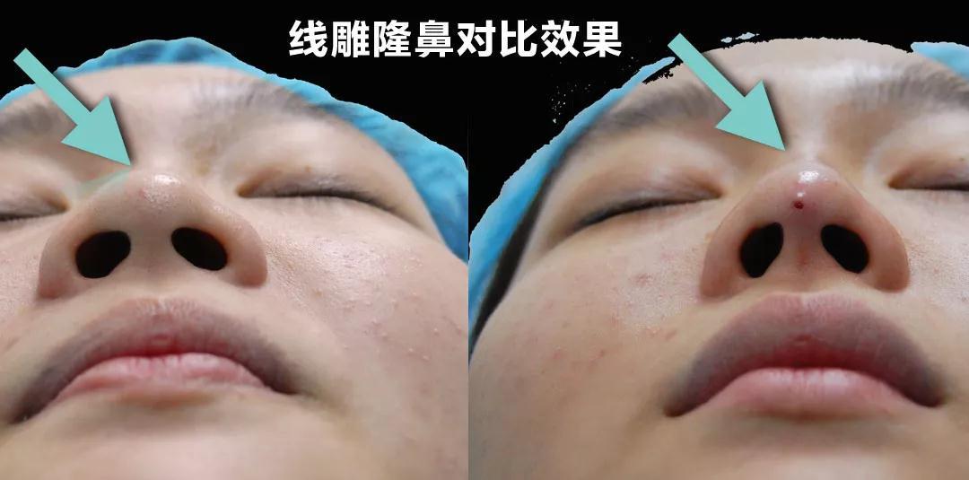 那些线雕隆鼻失败的人,后来变成什么样子了?