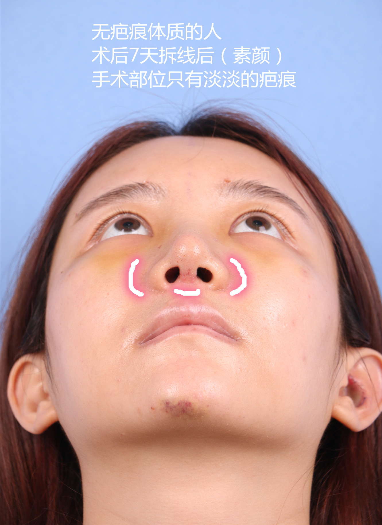 97隆鼻术后疤痕增生成因及应对方法96做完隆鼻手术一段