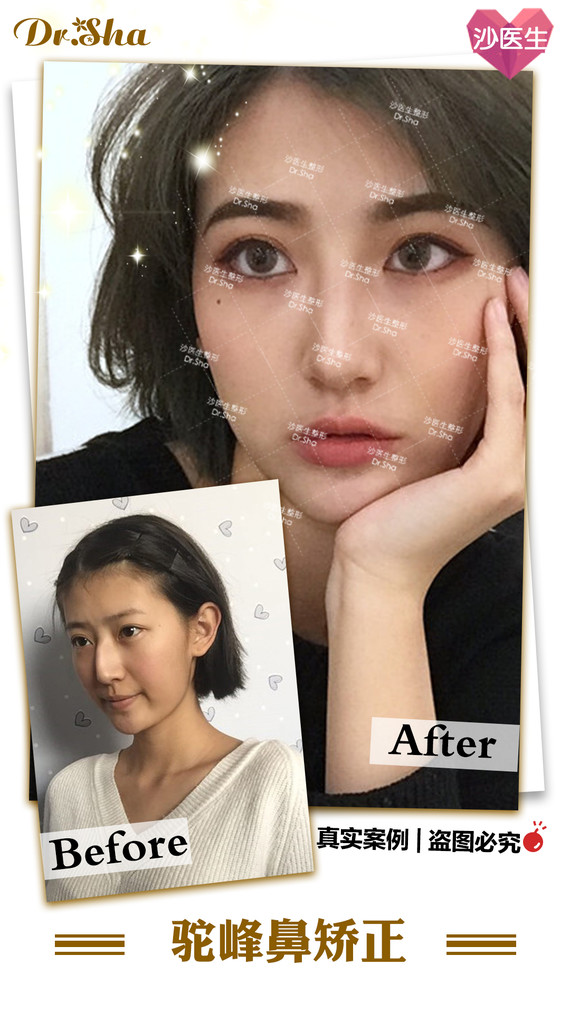 几款鼻综合效果 你喜欢哪一个 很多人不理解什 圈子 新氧美容整形