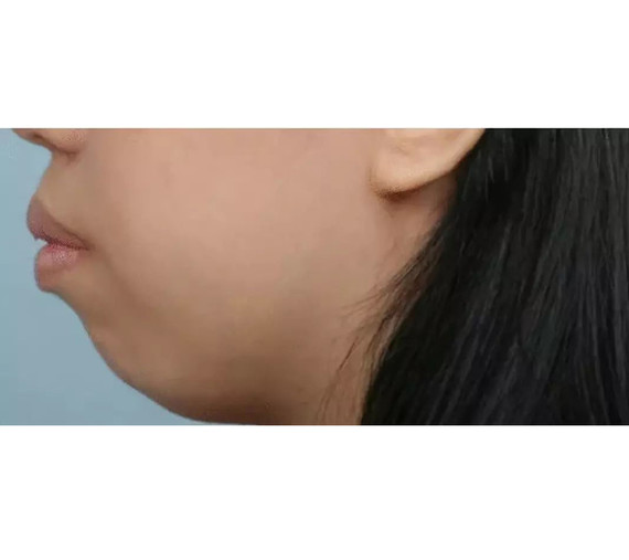 03~骨性 · 突嘴 下巴后缩型,是上颌发育过度 下颌发育不良,但