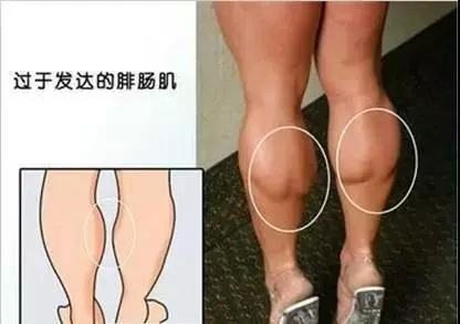 打几次可以告别萝卜腿?瘦腿针国产进口怎么选?