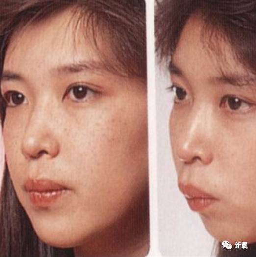 看不出咬合,但羊观察妹纸的嘴唇和下颌,妹纸应该有轻微的深覆合