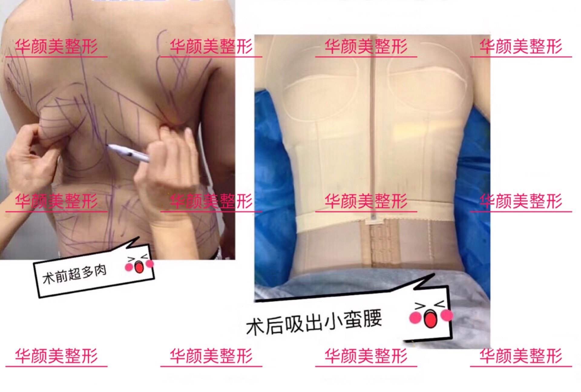 肚子上的肉很多 皮还很松 想一起做腹 新氧美容整形