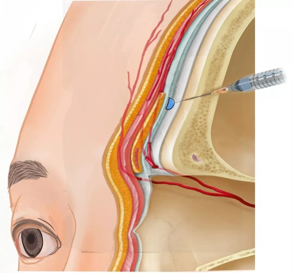 玻尿酸注射一般都位于这个层次