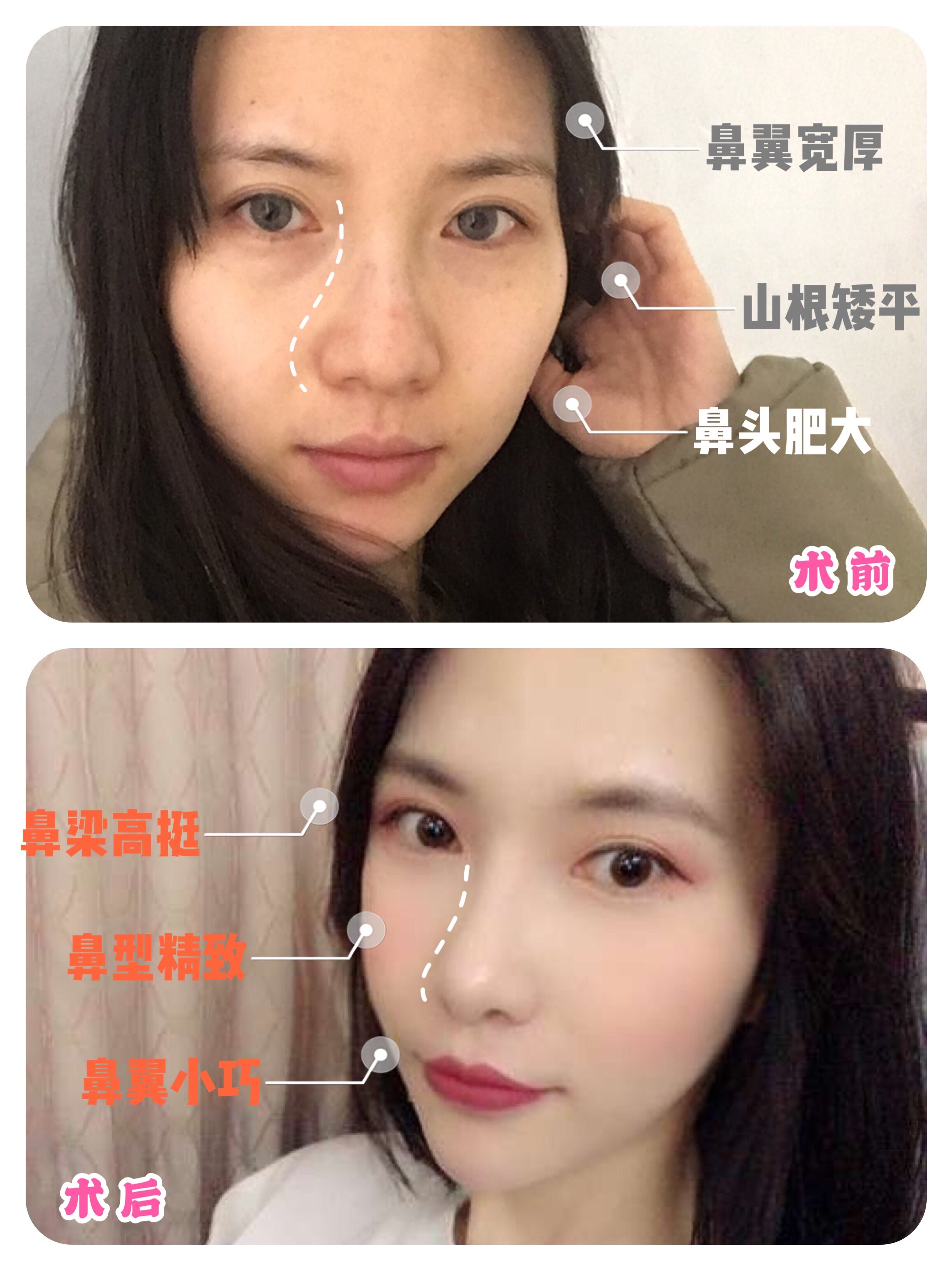 矯正 小鼻