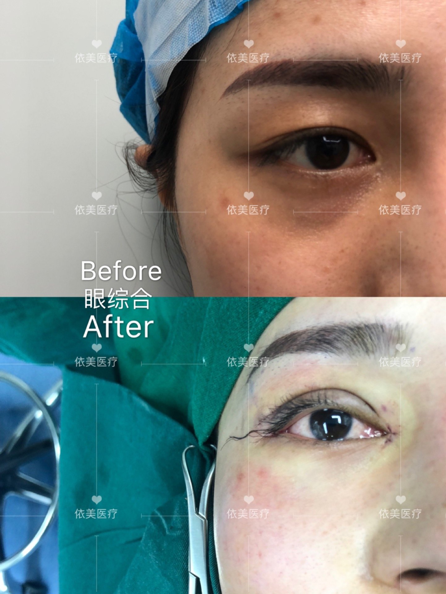 眼综合包括什么呢?