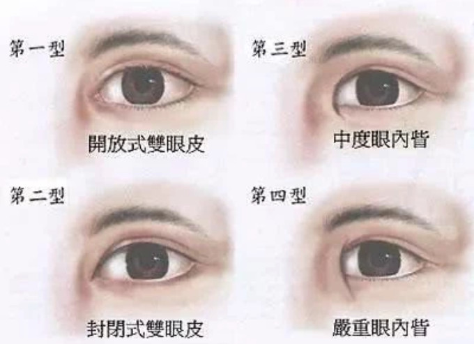 通常我们说的开眼角都是开内眼角,就是切除内眦赘皮的手术,一般适用于