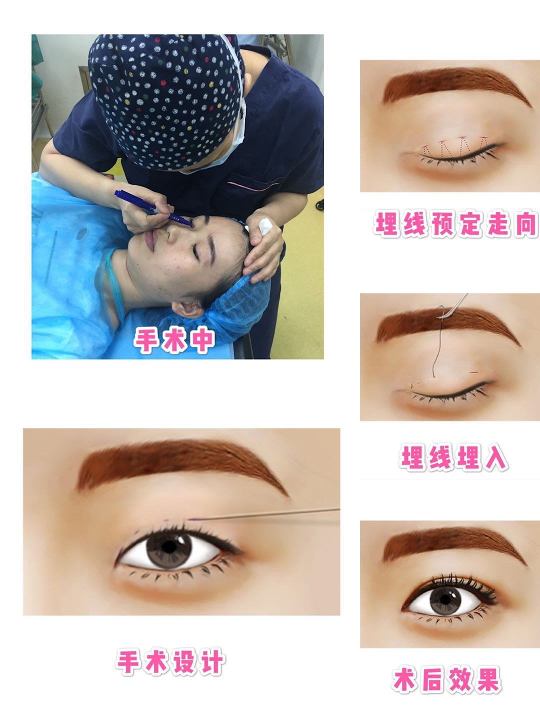 双眼皮手术中的埋线埋的是什么线呢?对身体有危害吗?