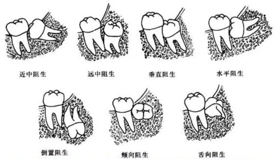 但智齿阻生有非常多种类型,如果智齿萌出不够多,用钳子根本夹不迭它