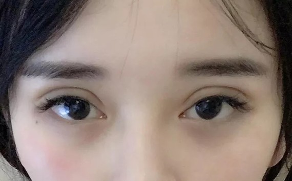 做的双眼皮能有多自然?