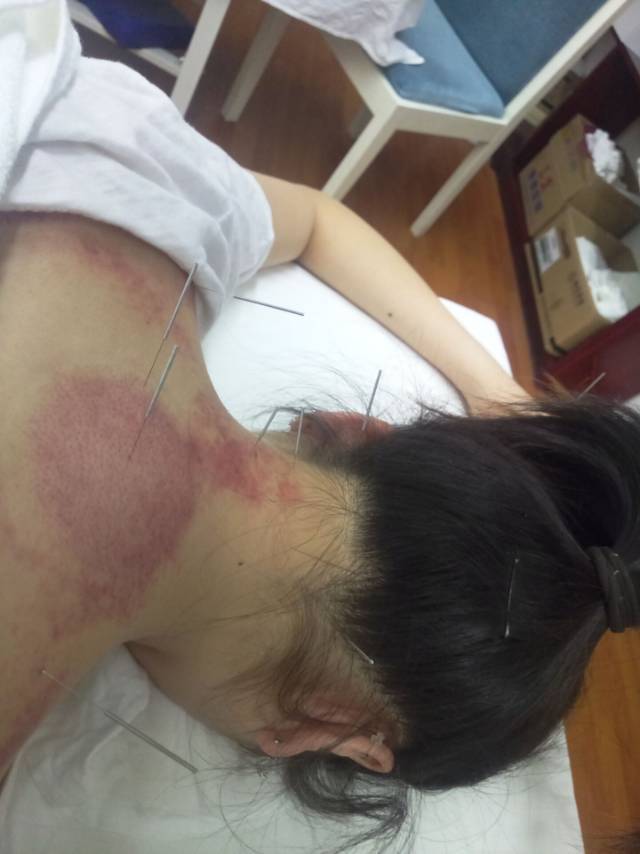 劲椎病针灸,刮痧拔罐!感觉自己蛮勇敢?其实港真,有点疼!